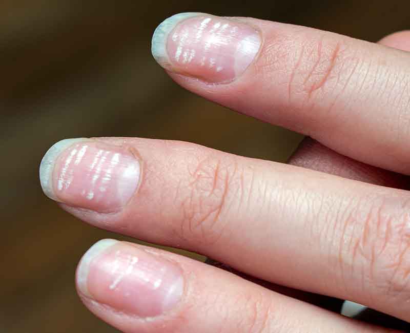 Leukonychia Explained: Common Causes of White Spots on Nails