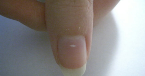 White Spots on Nails: When to Worry & What to Do Next